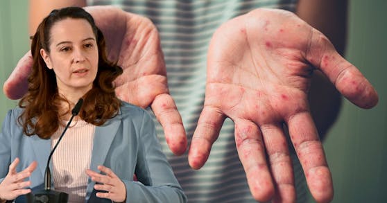 Die Wiener Virologin Monika Redlberger-Fritz kennt das Krankheitsbild genau.