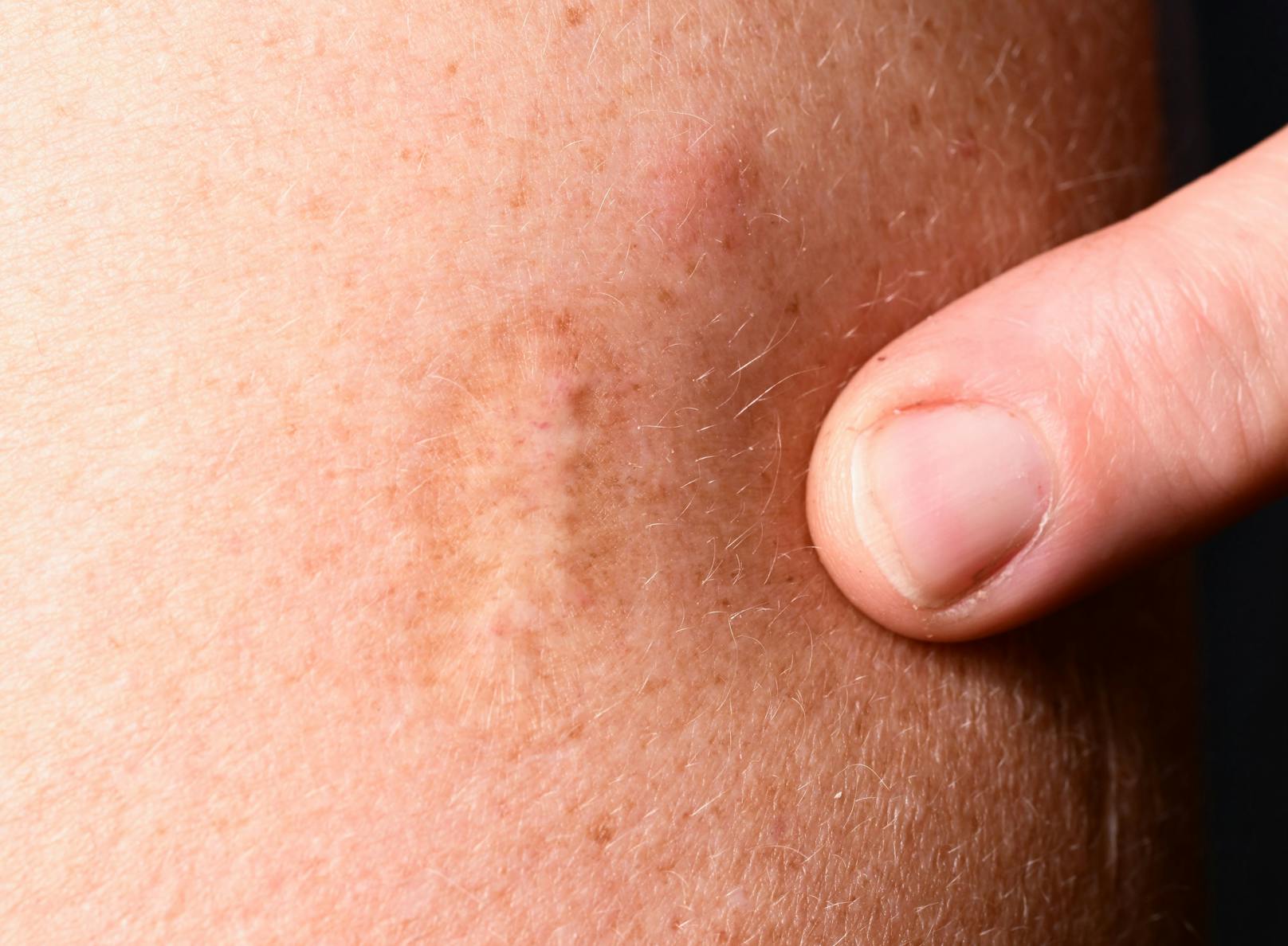 Wer gegen Pocken geimpft wurde, hat die typische Pockenimpfnarbe am Körper.