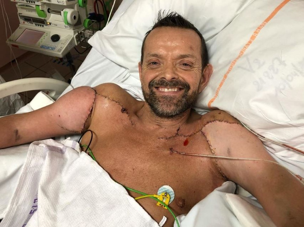 Felix Gretarsson nach seiner doppelten Arm-Transplantation.