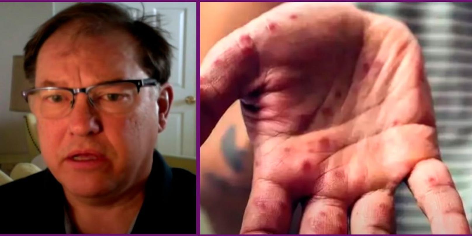Tierarzt Dr. Kurt Zaeske zeigt seine damaligen Läsionen auf seiner Handfläche.