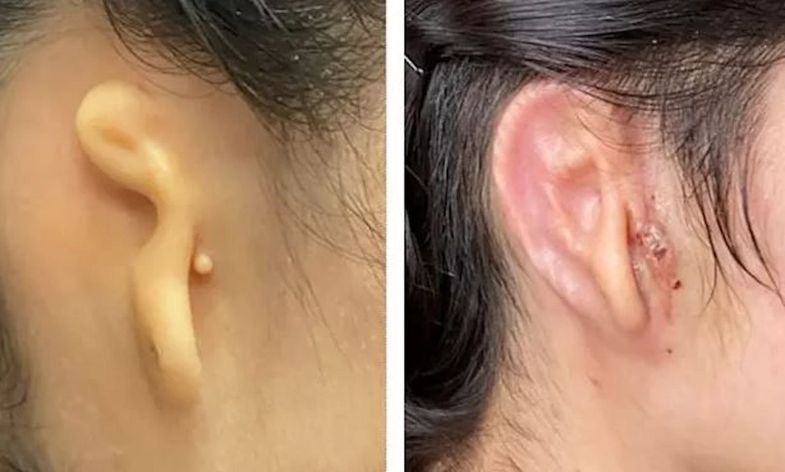 Das Ohr der Patientin vor und nach der Operation.&nbsp;