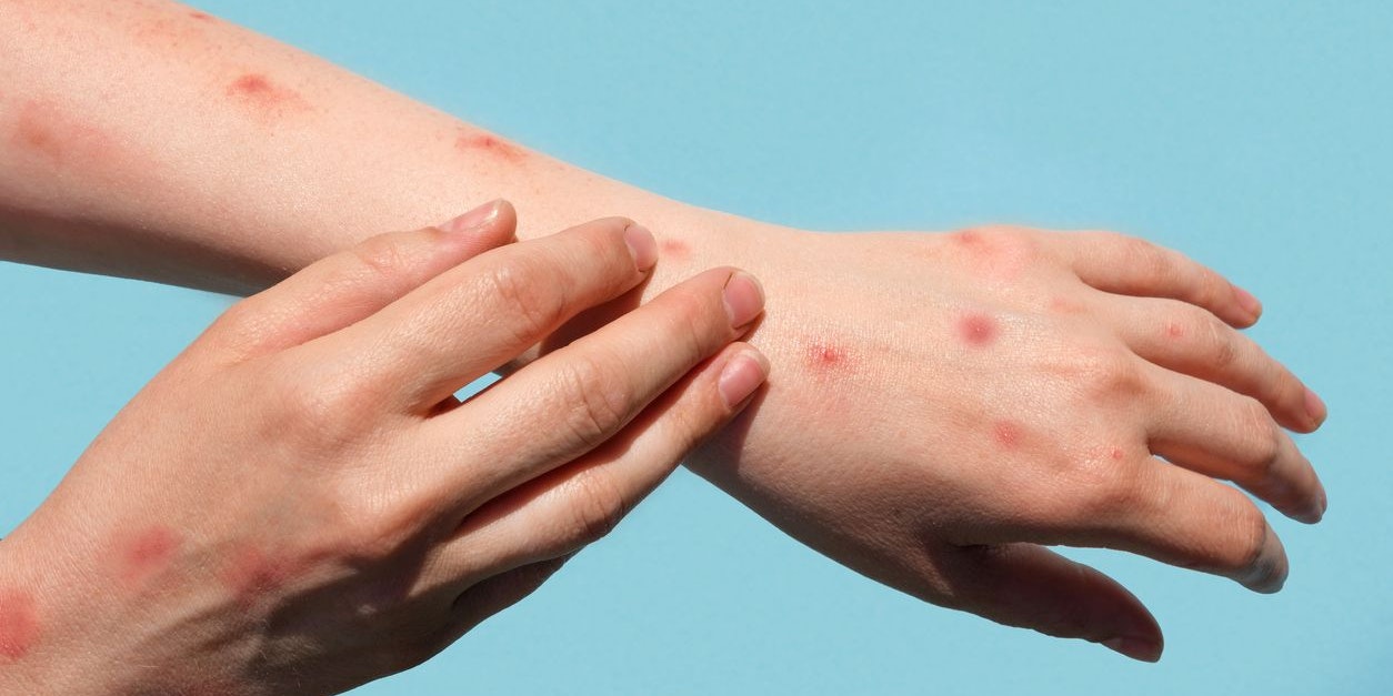 Monkeypox new disease dangerous over the world. Patient with Monkey Pox. Painful rash, red spots blisters on the hand. Close up rash, human hands with Health problem. Banner, copy space. Painful rash, red spots blisters on the hand. Close up Allergy rash, human hands with dermatitis and Health problem. Ill eczema skin of patient. Viral Diseases. Red rashes on the palm. Enterovirus. coxsackie