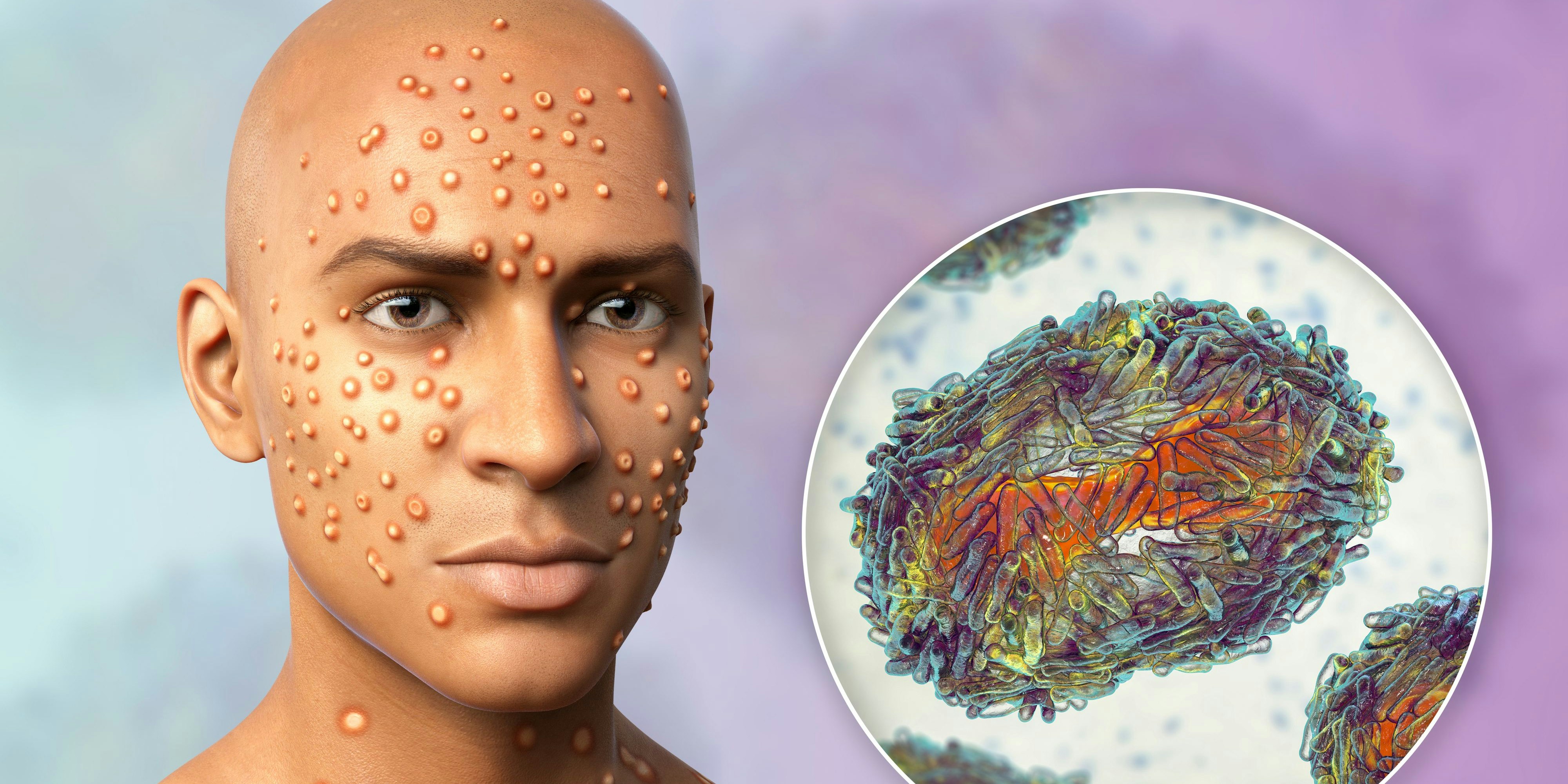 Patient mit Affenpocken (Computer-Animation)