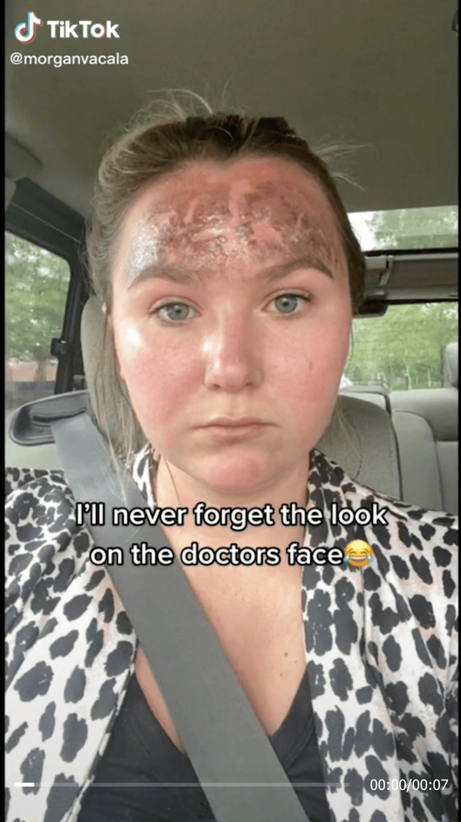 Wie die junge Frau auf Tiktok erklärt, hat sie sich auf der Stirn Verbrennungen zweiten Grades zugezogen – weil sie abgelaufene Sonnencreme verwendet hat.