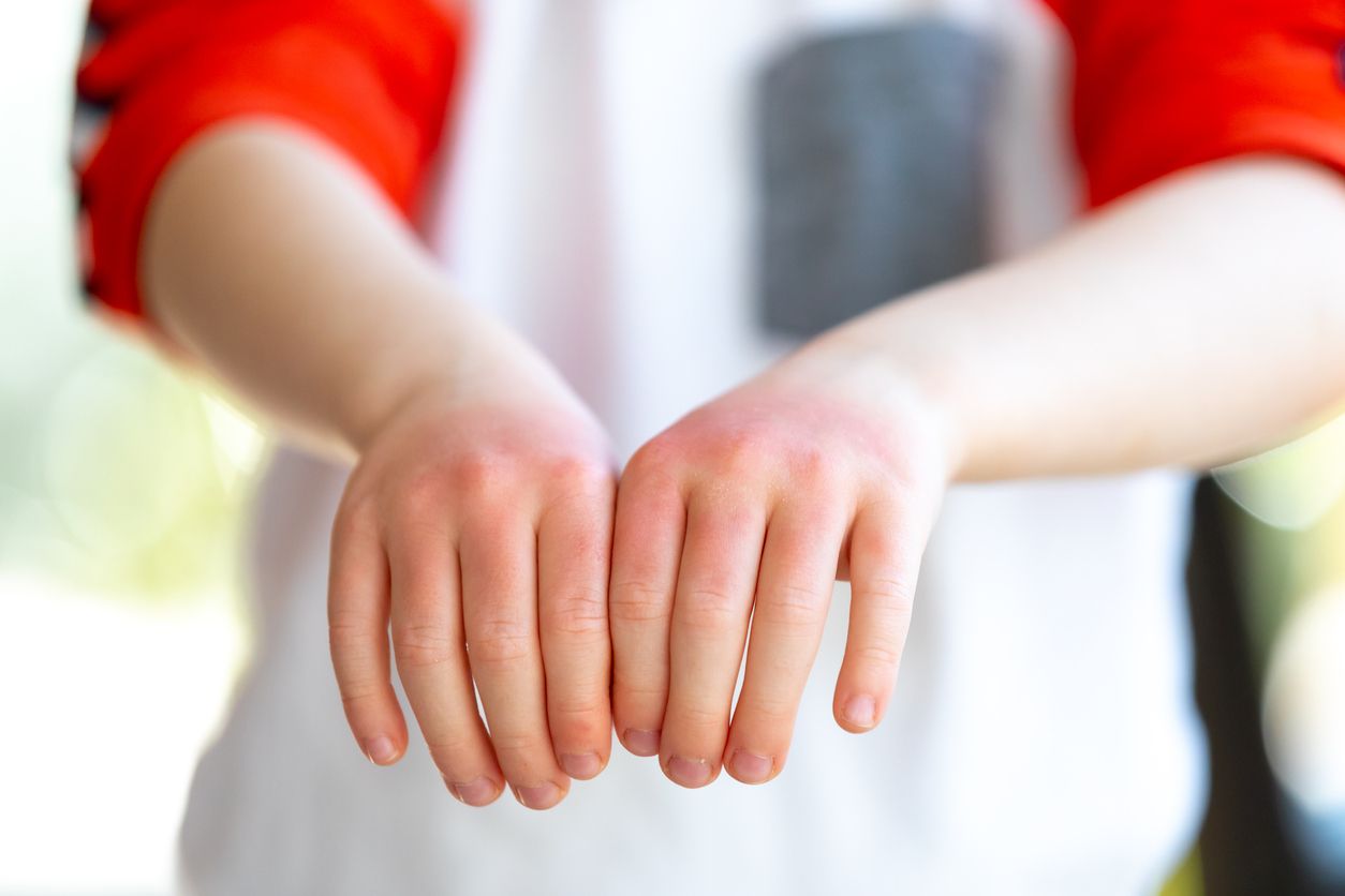 A little redhead boy is showing the sunburn he has on his hands. His hands are very red and dry.