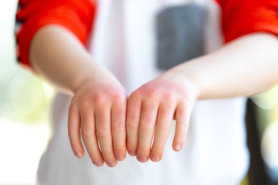 Laut Ärzten werde es bis zu zwei Jahren dauern ehe die Verbrennungen bei der 10-Jährigen verheilt sind. (Symbolbild)