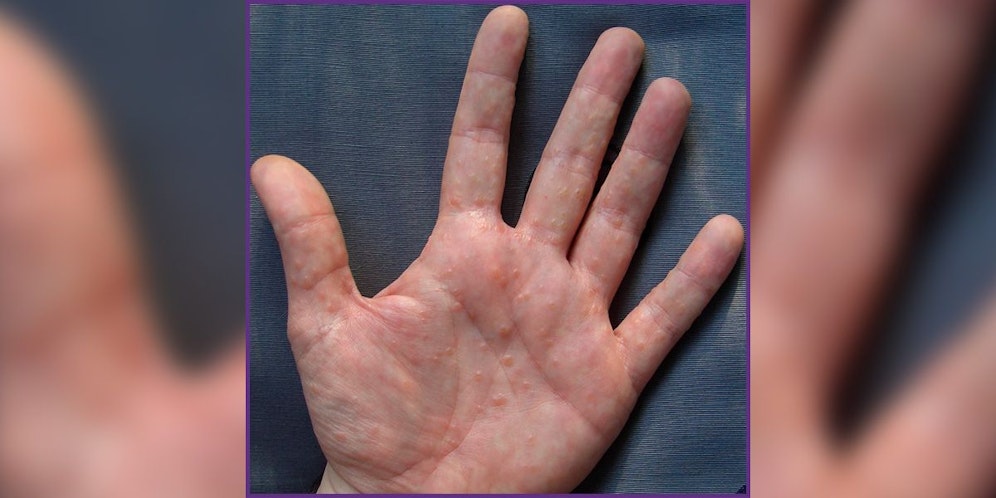 So sieht die&nbsp;Dyshidrose aus.