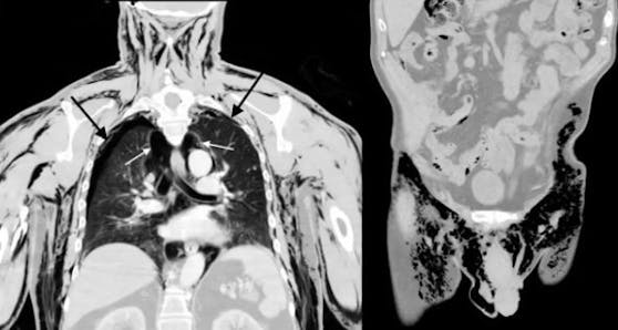 Ein CT-Scan der Brust des 72-jährigen Mannes (links). Die schwarzen Pfeile zeigen die kollabierten Lungen, während die weißen Pfeile auf Lufteinschlüsse (feste schwarze Bereiche) zeigen, die zwischen dem Innenraum außerhalb der Lunge und innerhalb der Brustwand eingeschlossen sind. Der&nbsp;Unterleib des Mannes (rechts) zeigt die Luftmenge (schwarze Bereiche) in seinen Oberschenkeln und seinem Hodensack.&nbsp;