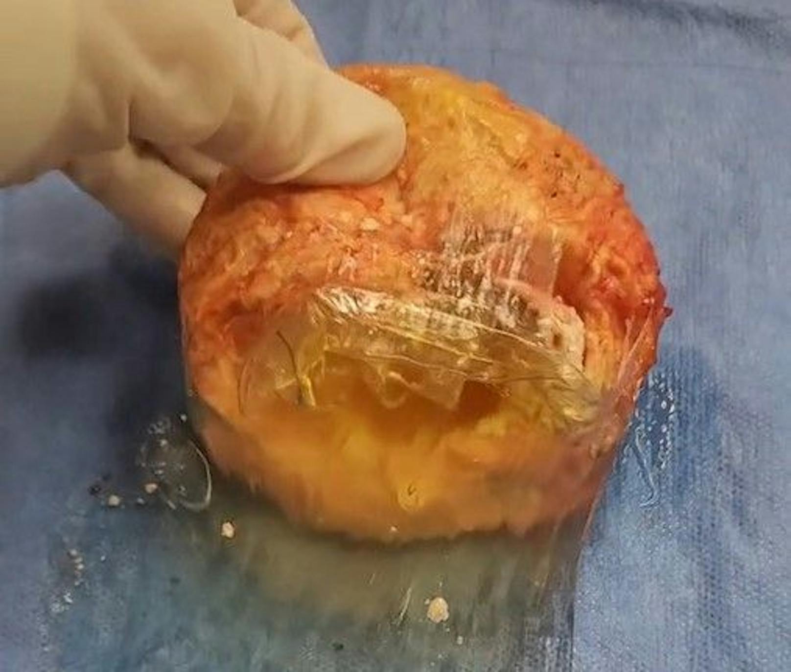 Dr. Castellese zeigt auf TikTok das beschädigte Implantat.&nbsp;