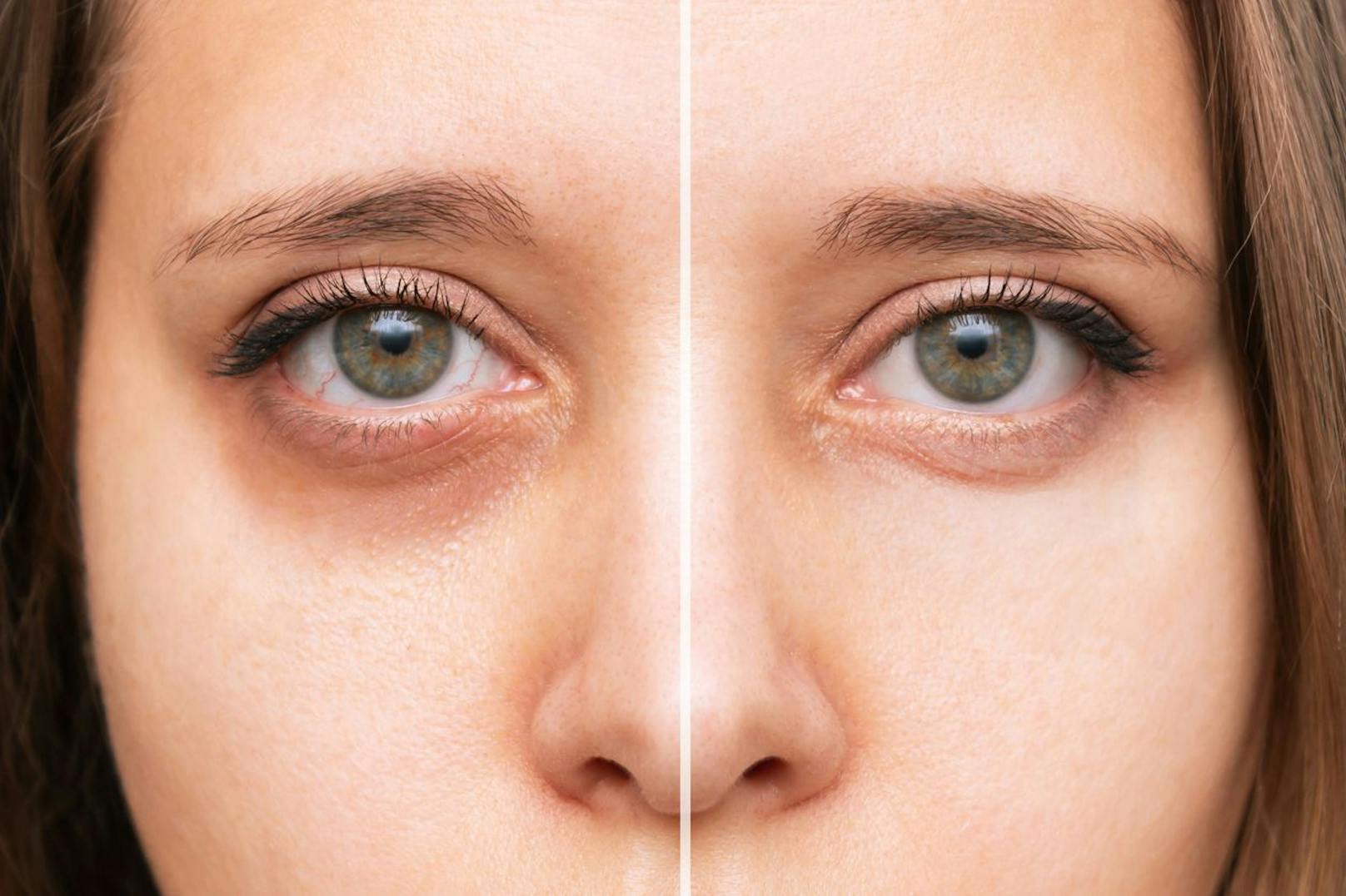 Wenn du kein Fan von Injektionen bist, dann kannst du mittels einer CC EYE-Behandlung deine dunklen Augenstellen aufhellen. Das geschieht in dem Farbpigmente auf deine Haut gerieben werden. Diese werden eingebracht und bewahren die Epidermis davor geschädigt zu werden.