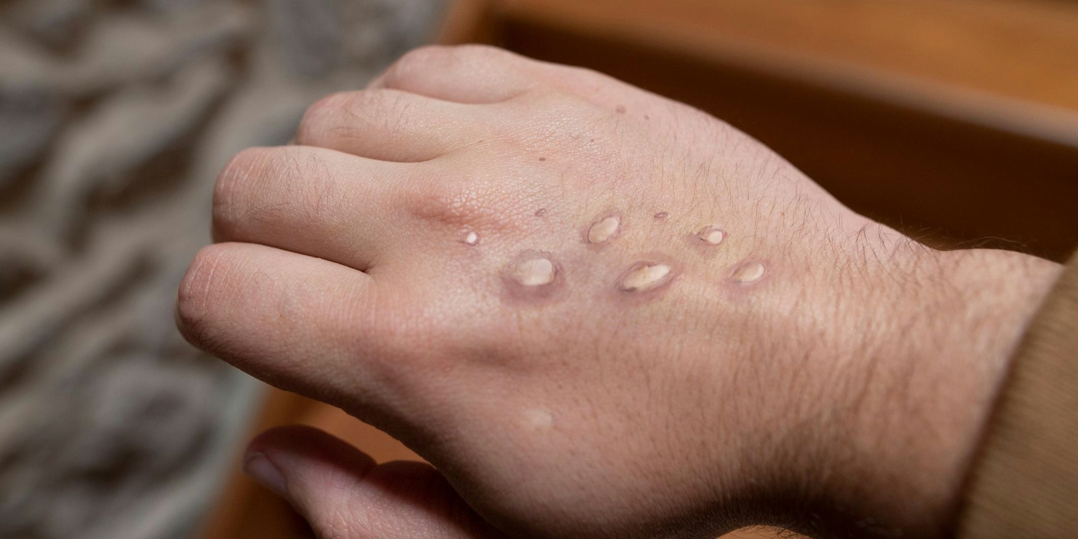 Die für Affenpocken typischen Hautläsionen auf einer Hand. 