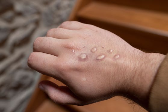 Die für Affenpocken typischen Hautläsionen auf einer Hand. 