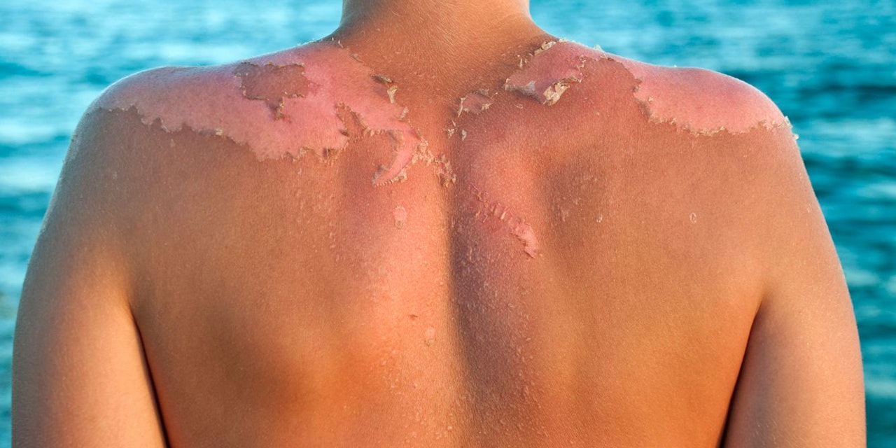 Haut Schält Sich Nach Sonnenbrand Trotzdem Braun Gesundheit – Haut schält sich nach Sonnenbrand? Das hilft | Heute.at