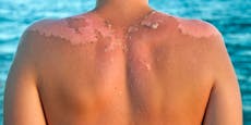 Haut schält sich nach Sonnenbrand? Das hilft