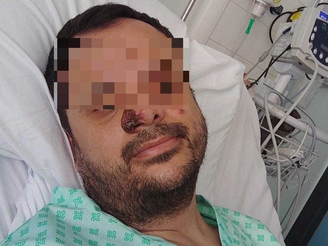 Die Weltgesundheitsorganisation (WHO) hat am 23. Juli 2022 den Affenpocken-Ausbruch in mehr als 50 Ländern zu einer «Notlage von internationaler Tragweite» erklärt.