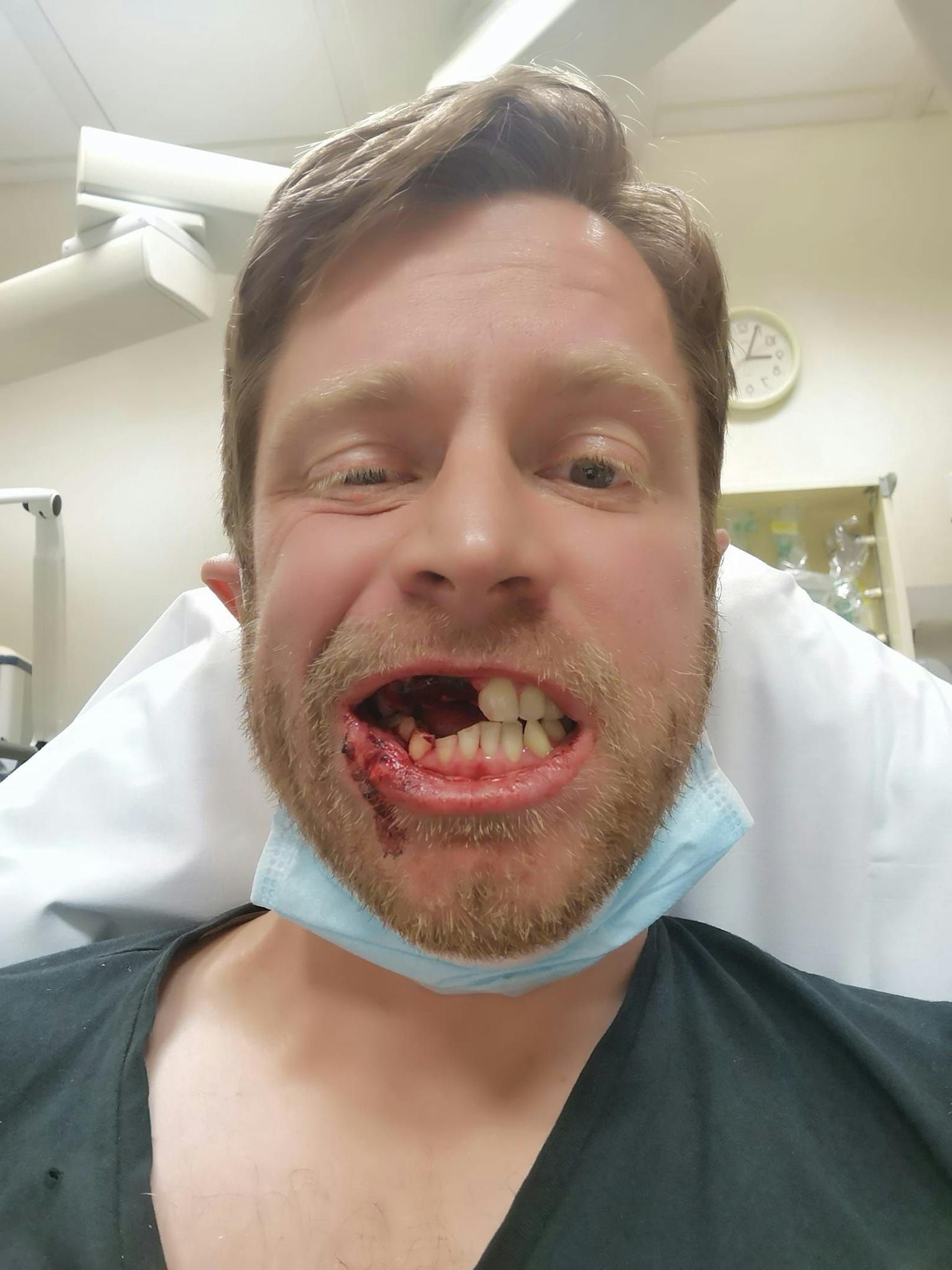 Zähne weg – E-Tschick explodiert plötzlich in Mund