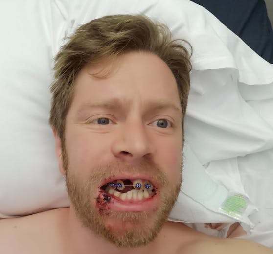 Der Mund des Briten ist so stark beschädigt, dass insgesamt sieben Zähne durch Implantate ersetzt werden müssen.