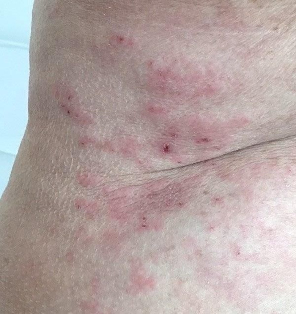 Nach dem Baden in warmen Gewässern können momentan Stiche von Entenflöhen auf der Haut auftreten.