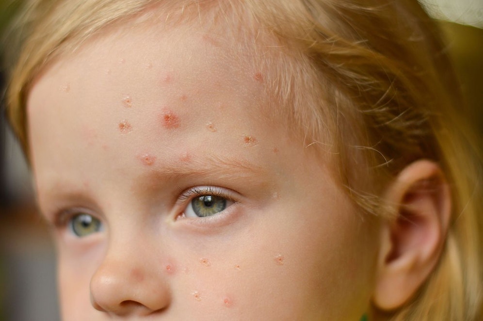 Die Gesundheitsbehörden untersuchen derzeit, wie sich die Kinder infiziert haben.