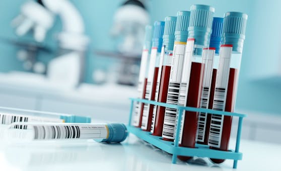 Obwohl Affenpocken durch Abstrich der Läsionen diagnostiziert werden, sind Bluttests notwendig, um das Virus von anderen Infektionsarten zu unterscheiden und eine klare Diagnose stellen zu können.