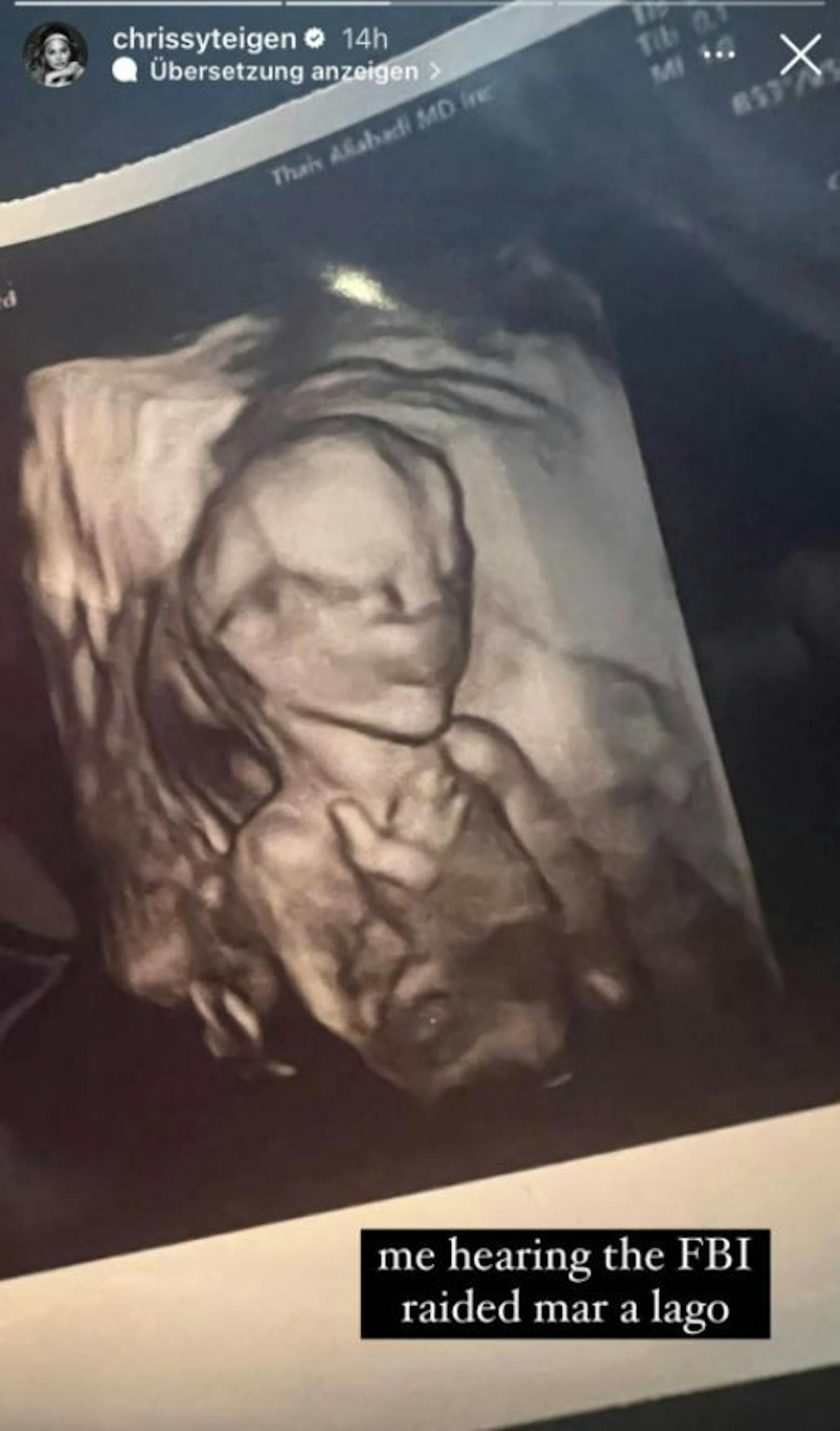 Ultraschallbild von Chrissy Teigens Baby