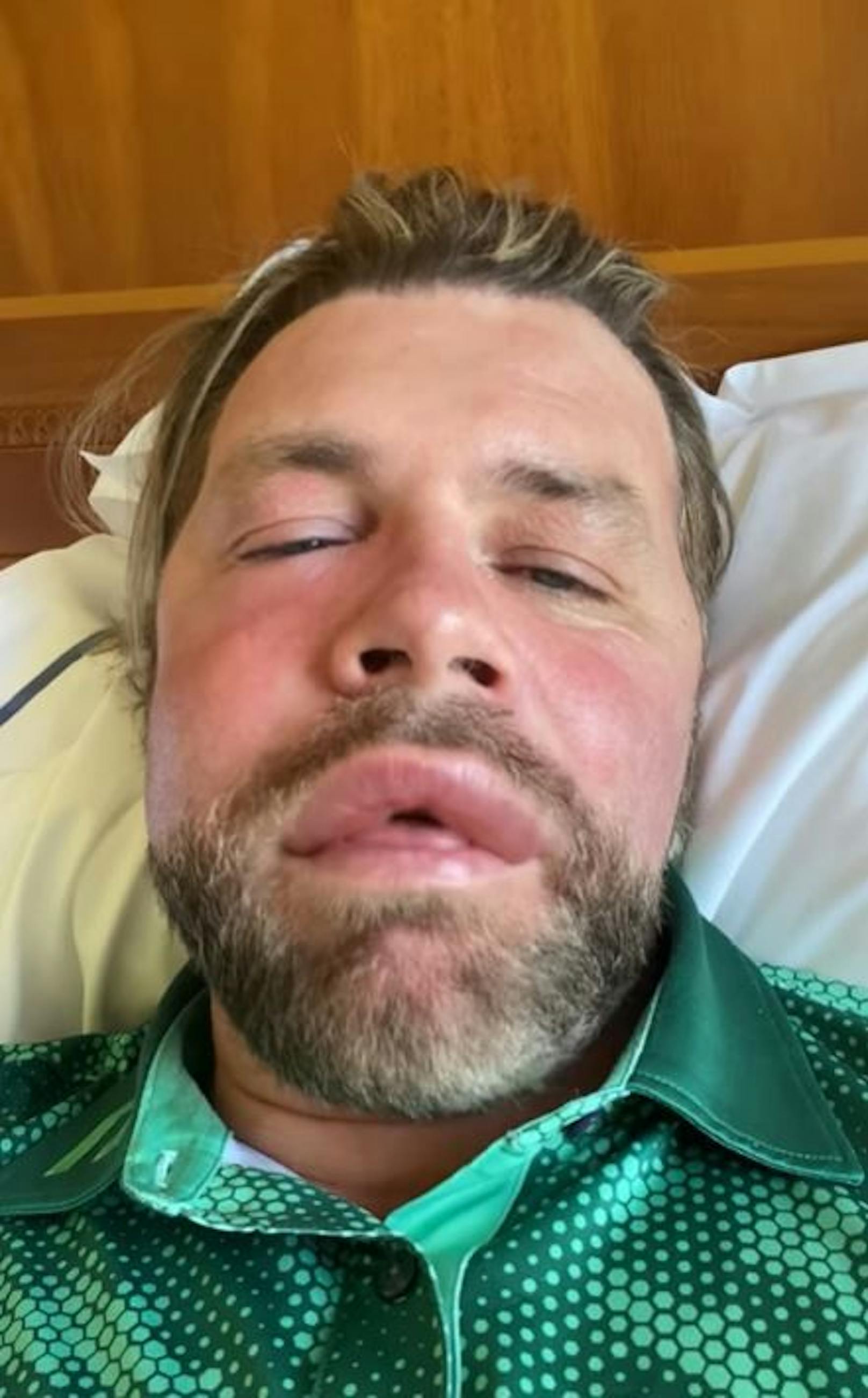 Popstar Brian McFadden wurde von einer Biene gestochen und erlitt dabei eine allergische Reaktion.