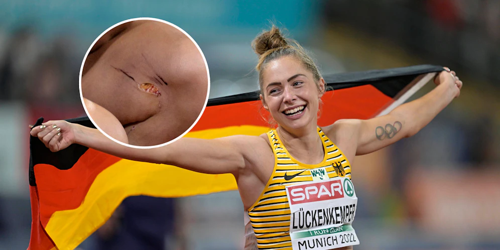 Gina Lückenkemper zog sich bei ihrem Gold-Sprint eine Fleischwunde zu.