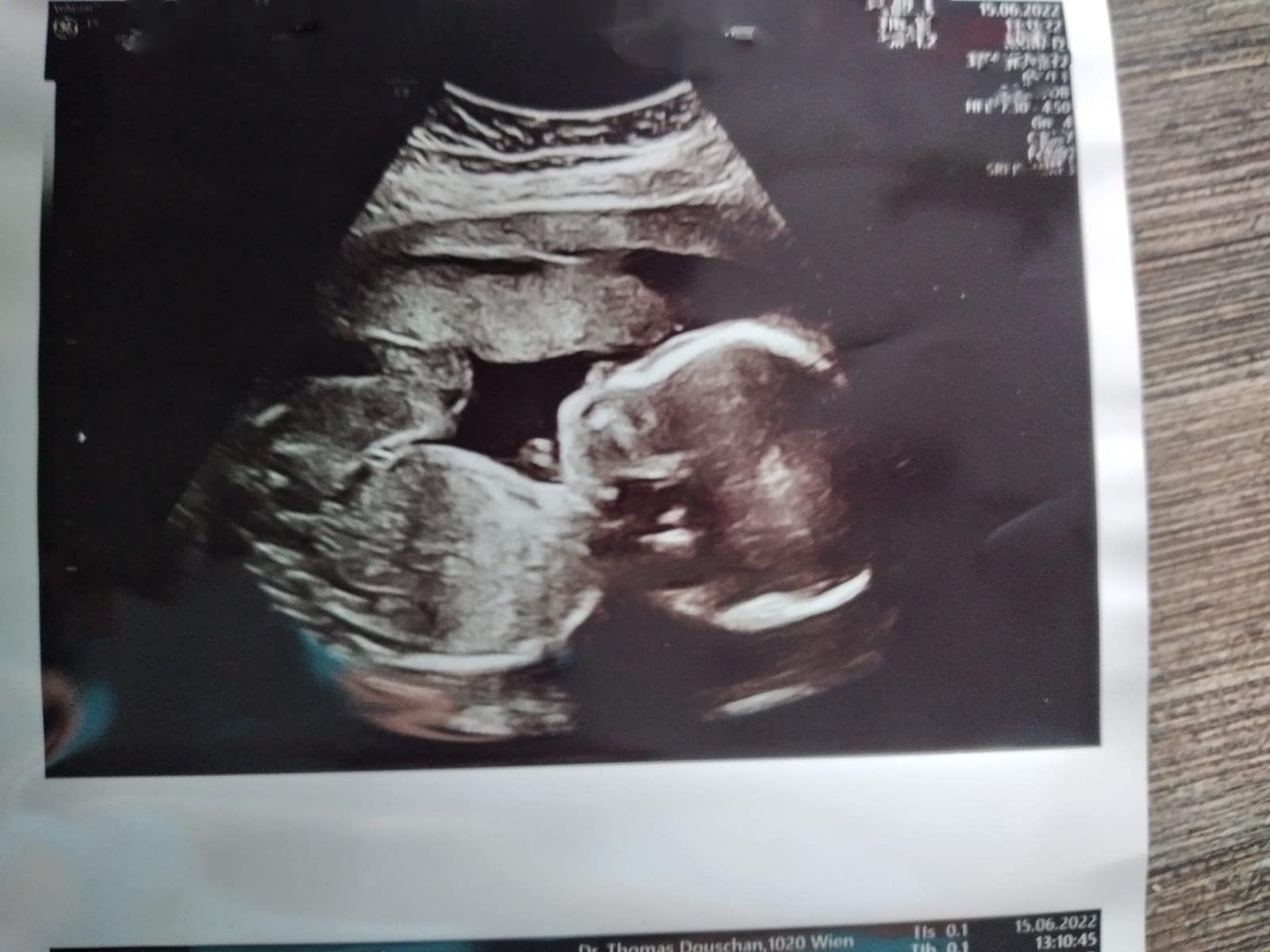 Die Niederösterreicherin Caroline F. erwartet im Oktober ihr erstes Kind (Bild). Nach dem plötzlichen Tod ihres Verlobten muss sie das Baby alleine großziehen.