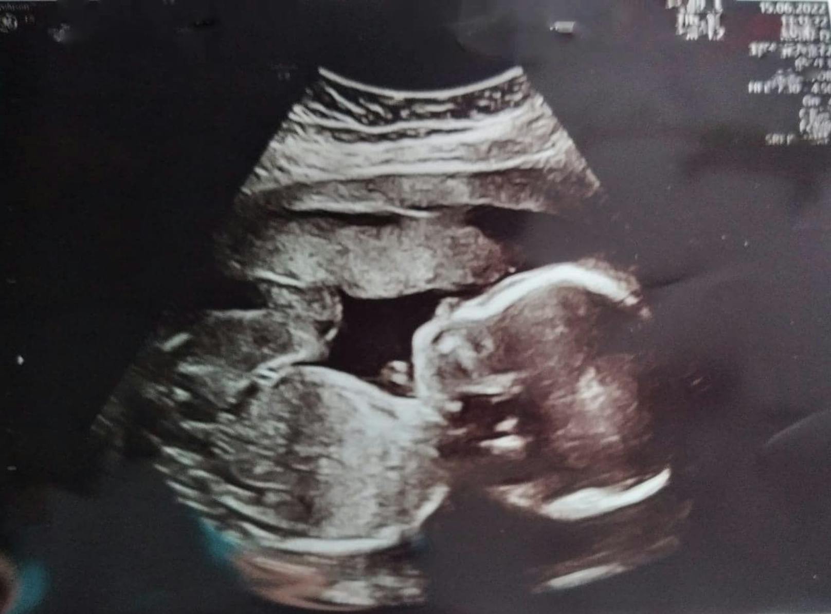 Die Niederösterreicherin Caroline F. erwartet im Oktober ihr erstes Kind (Bild). Nach dem plötzlichen Tod ihres Verlobten muss sie das Baby alleine großziehen.