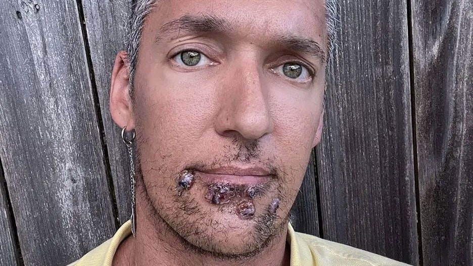 Affenpocken Silver Steele