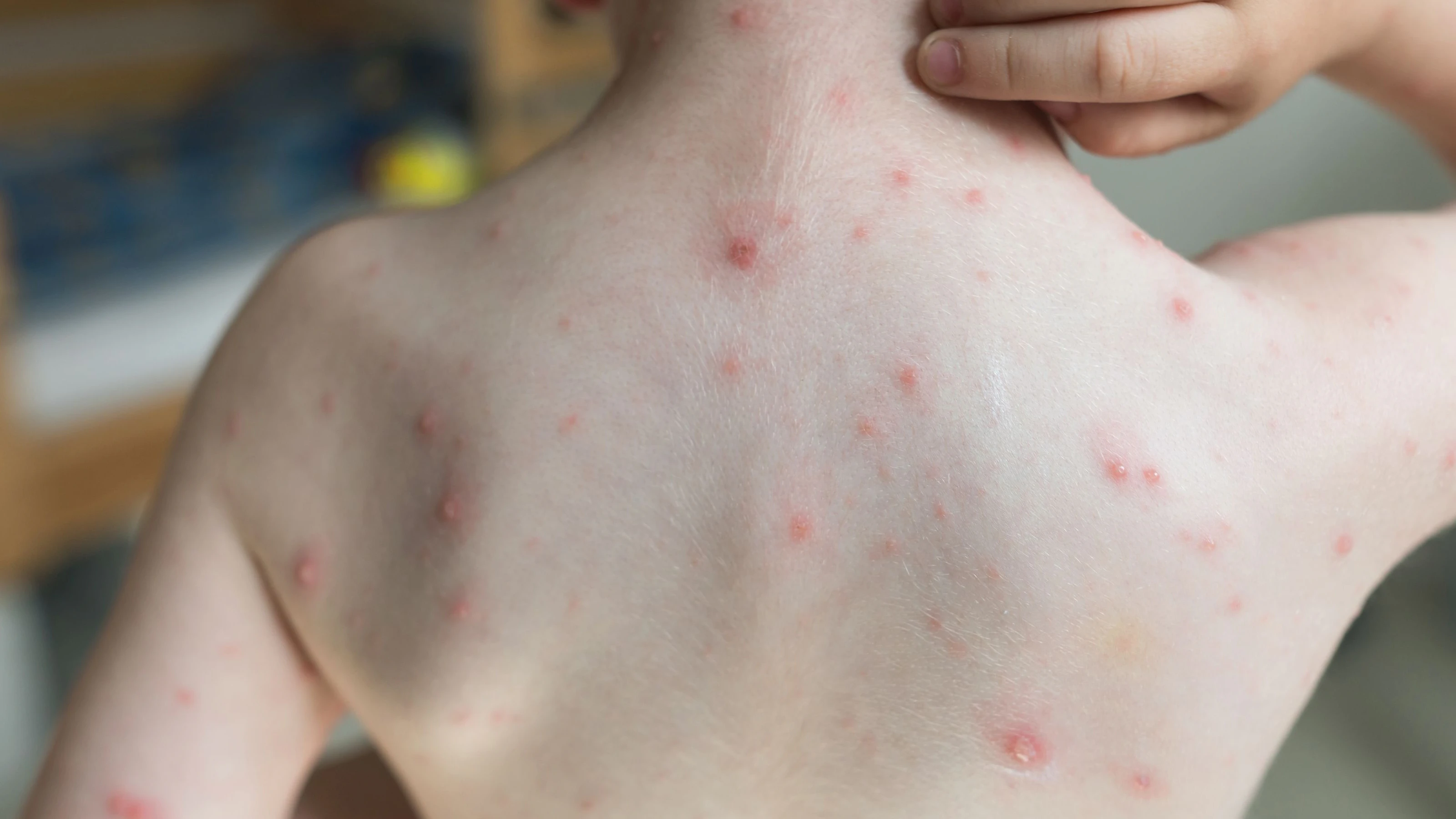 Rear view image of little boy with varicella zoster rash scratching his neck