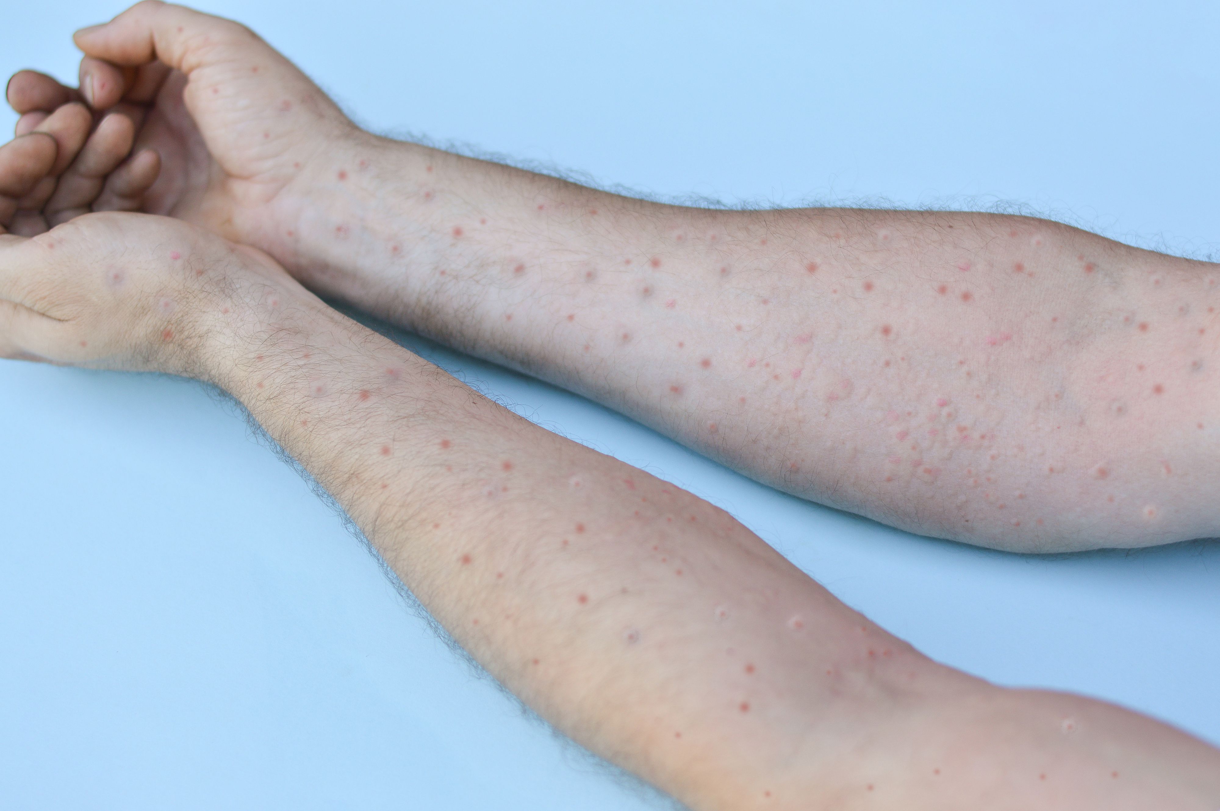 Das Tomatenfieber verursacht am gesamten Körper rote und schmerzhafte Bläschen.