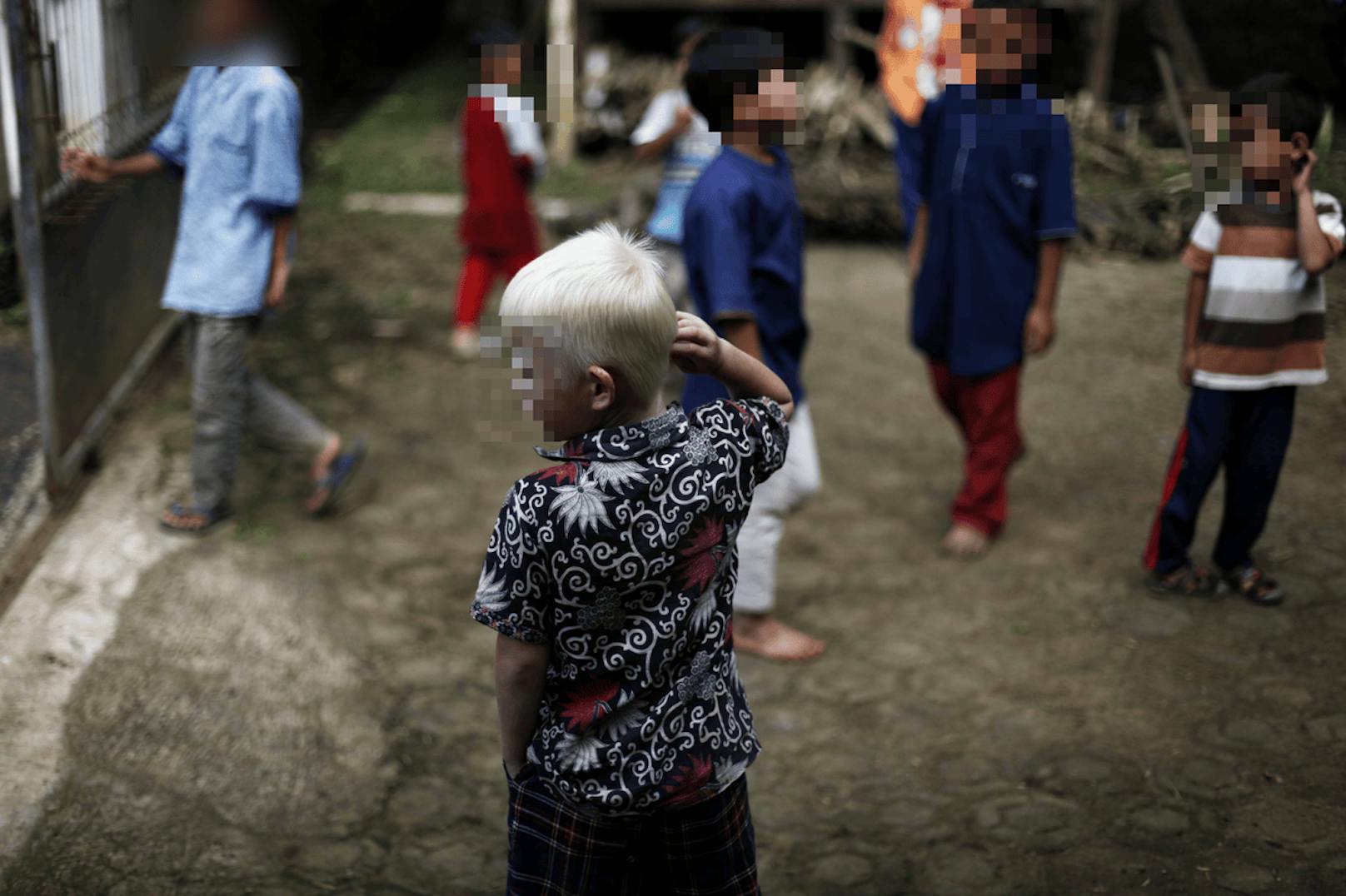 Ein Kind mit Albinismus ist in Madagaskar entführt worden (Symbolbild).