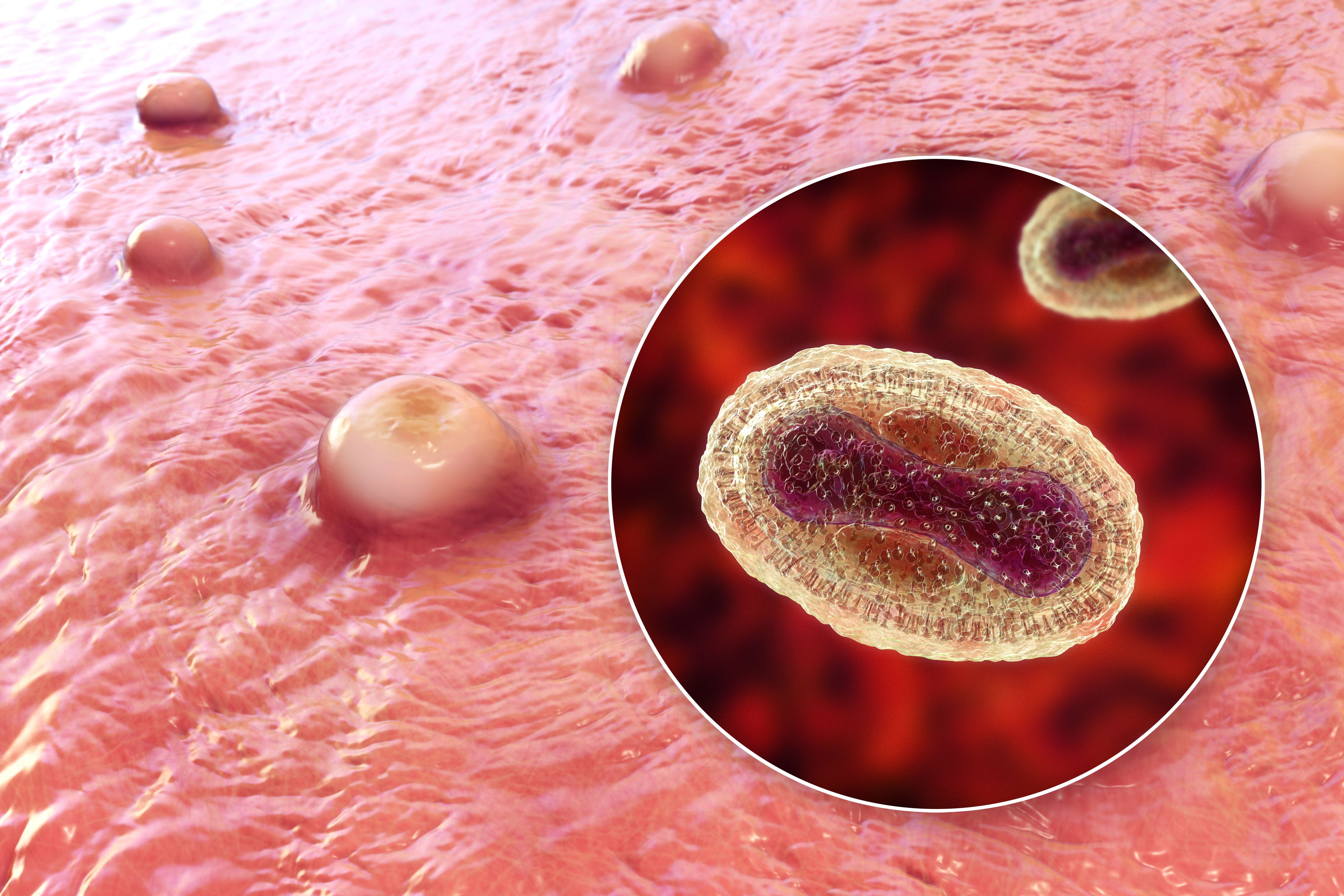 Download von www.picturedesk.com am 02.09.2022 (14:58).  Skin lesions in monkeypox infection and close-up view of monkeypox virus particles, computer illustration. Monkeypox virus is found near rainforests in Central and West Africa, causes disease in humans and monkeys, although its natural hosts are rodents. It is capable of human to human transmission. In humans it causes fever, swollen glands and a rash of fluid-filled blisters, shown in the illustration. It is fatal in 10 per cent of cases. - 20220615_PD0342 - Rechteinfo: Royalty Free (RF)