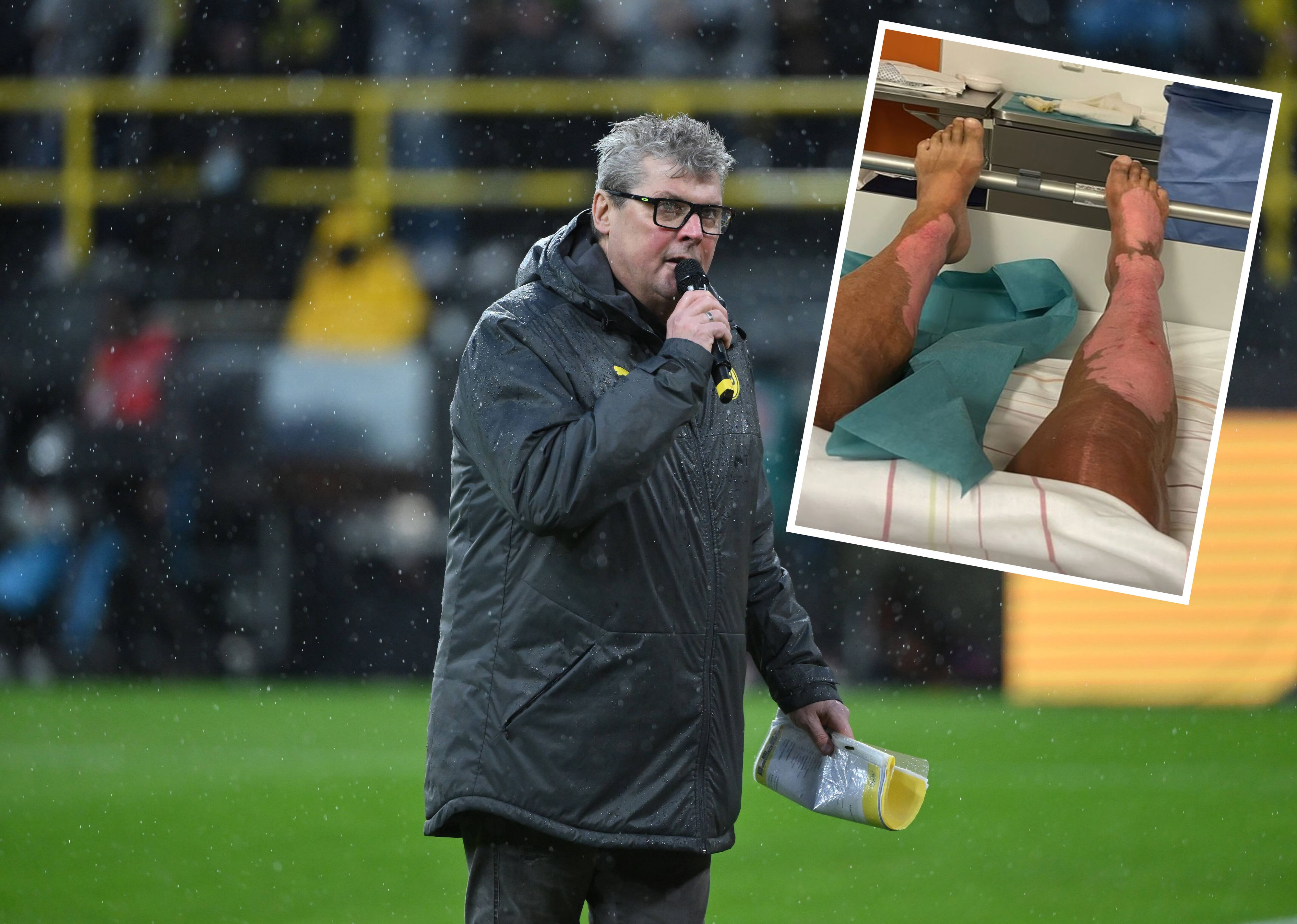 Norbert Dickel zeigt seine Brandwunden.