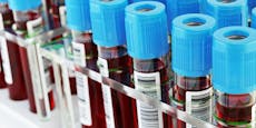 Bluttests könnten Krebs künftig zuverlässig aufdecken