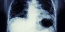 Neue Spur – warum Nichtraucher Lungenkrebs bekommen