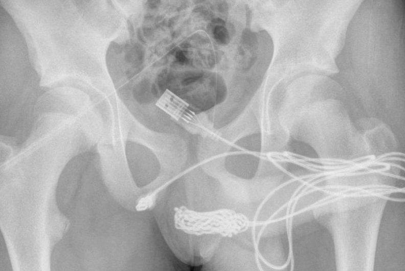 Das USB-Kabel musste von Ärzten entfernt werden.