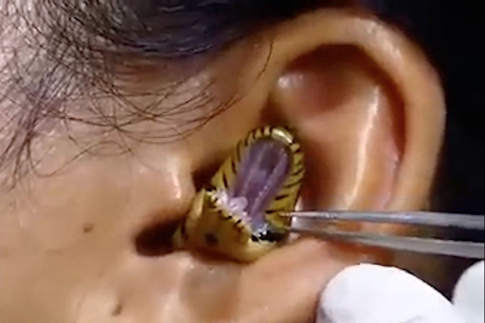 Ein Facebook-Clip, in dem ein Arzt eine Schlange aus dem Gehörgang einer Frau zu entfernen versucht, geht derzeit viral.