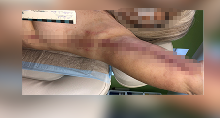 Eine der beiden entzündeten Narben Wochen nach der verhängnisvollen OP