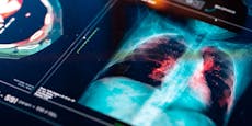 MRT zeigt Langzeit-Lungenschäden nach Covid bei Kindern