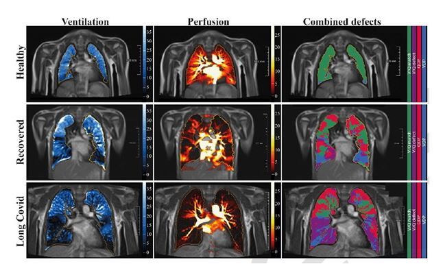 Man erkennt klar die Unterschiede bei gesunden, erholten und Long Covid-Patienten in Atmung und Blutfluss. (von oben nach unten).