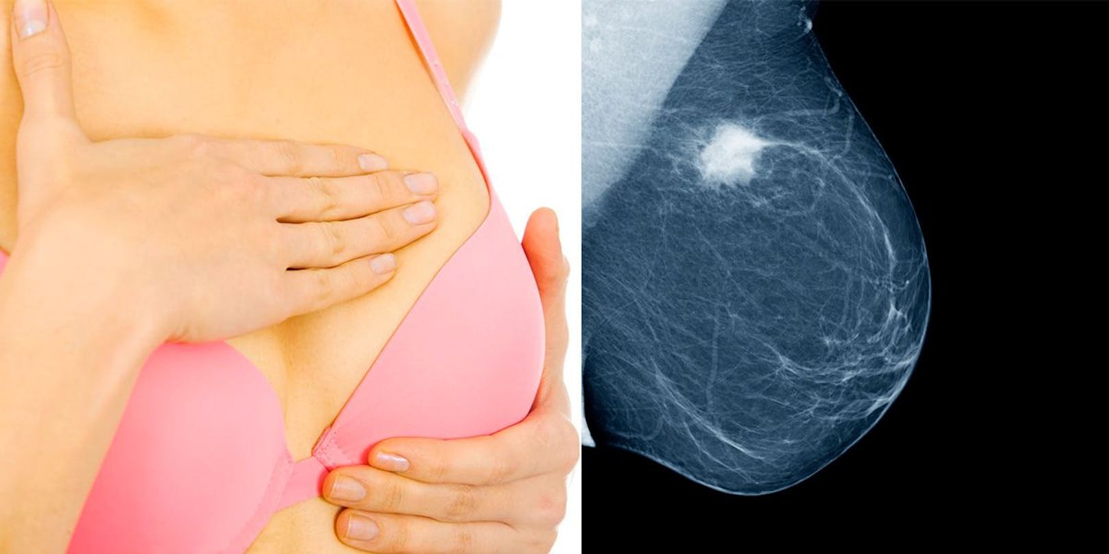 Brustkrebs ist die häufigste Krebserkrankung der Frau mit 5.000 bis 5.500 neuen Fällen pro Jahr in Österreich.