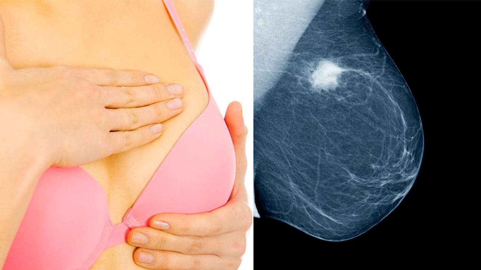 Brustkrebs in der Familie – so bestimmst du dein Risiko