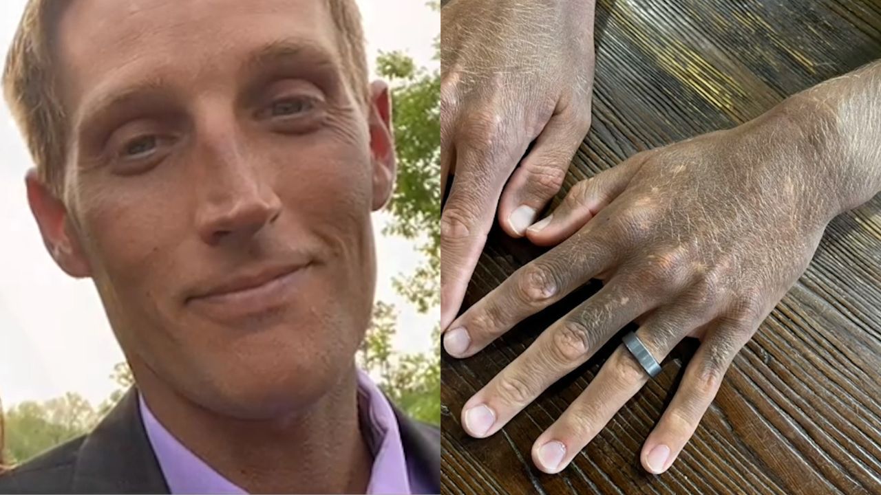 Download von www.picturedesk.com am 13.10.2022 (11:58).  ACT action_40046814 -- A man is a 'medical mystery' after a commonly prescribed anti-depressant drug has changed his skin colour from white to dark grey - SWSMskin.A man has the medical profession scratching their heads after a 'mystery' reaction to a commonly prescribed drug changed his skin colour from white - to dark grey Tyler Monk, 34, was prescribed an anti-depressant last year after consulting a doctor for his mental health But the treatment failed to help his mental health - but did change the colour of his skin Tyler was given Fluoxetine, a type of antidepressant known as a selective serotonin reuptake inhibitor (SSRI), that is commonly prescribed to treat depression He started taking the drug in May 2021, but within a week Tylers wife, Emily, 28, noticed that his skin colour was changing Tyler, a pest control field inspector, stopped the medication after only a few weeks as it wasnt helping his mental health, but his skin continued to darken First, his ears started to change colour before it rapidly spread to his neck and his face - before effecting his arms and hands Tyler also experienced other symptoms such as extremely red, irritated eyes and his skin is now very sensitive to the sun and it feels like it has been burned He admits to being in denial at first, but after speaking to two of his co-workers, Tyler accepted he was actually turning grey Tyler has visited several specialists near the couple's home in Kinder, Louisiana, USA, since the discolouration, but they have all been stumped Doctors have ruled out any serious diseases, poisoning and autoimmune conditions - but they still can't tell the monks what is causing the problems Tyler's dermatologist has now referred him for an appointment with a team of eight skin specialists, which is an exciting breakthrough in a seemingly unsolvable case Ahead of his visit with the specialists, Tyler - 20220929_PD0990 - Rechteinfo: Rights Managed (RM)