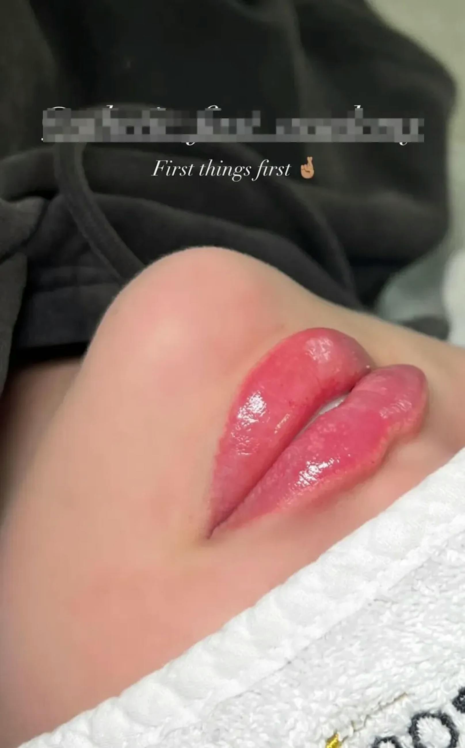 Das Erotik-Model postet am Mittwoch eine Story davon, wie sie sich ihre Lippen aufspritzen ließ.