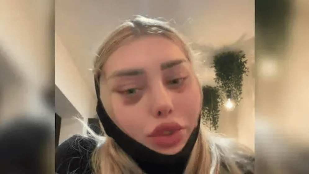 Ein Horror-Szenario ereignete sich bei Tiktok-Star Weronika: Nach einer Schönheits-OP platzten ihre Nähte – im Flieger!