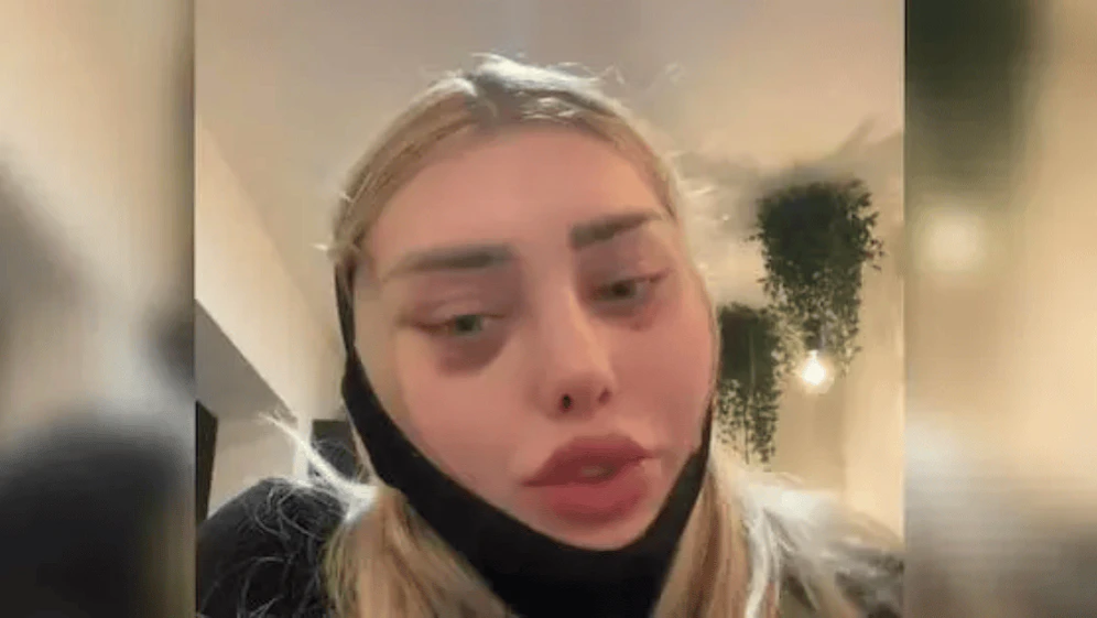 Ein Horror-Szenario ereignete sich bei Tiktok-Star Weronika: Nach einer Schönheits-OP platzten ihre Nähte – im Flieger!