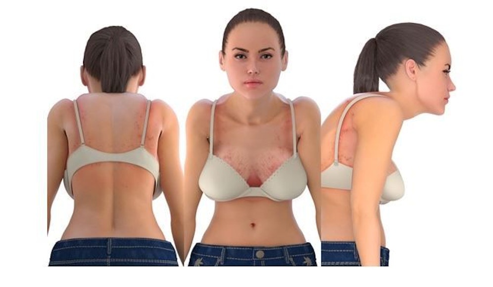 Einschneidende BH-Träger, schlechte Haltung, Scheuerwunden, Hängebrust und Dehnungsstreifen – das und mehr kann ein schlecht sitzender BH verursachen.