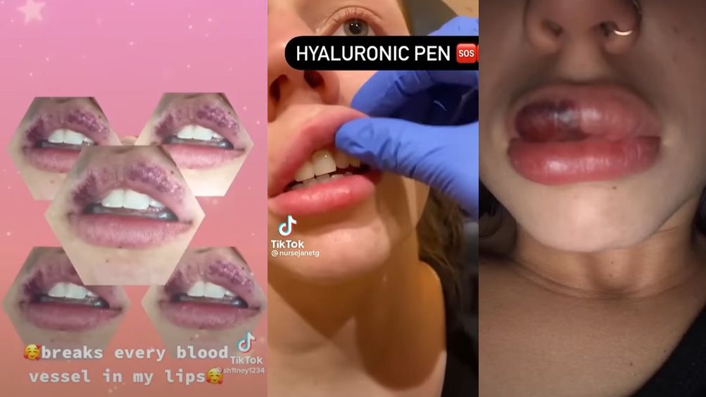 Unfälle wie diese mit einem Hyaluron-Pen können die Lippen nachhaltige schädigen. 